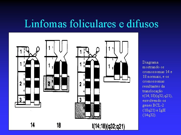 Linfomas foliculares e difusos Diagrama mostrando os cromossomas 14 e 18 normais, e os