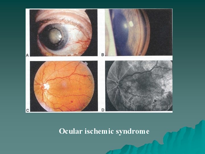 Ocular ischemic syndrome 