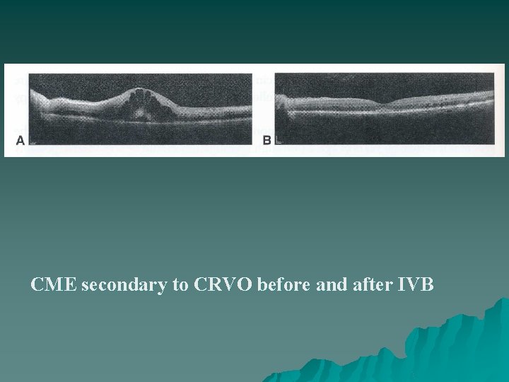 CME secondary to CRVO before and after IVB 