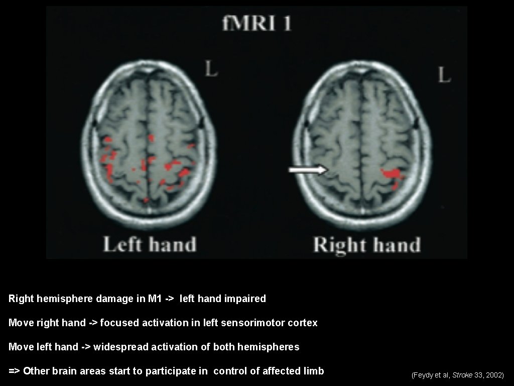 Right hemisphere damage in M 1 -> left hand impaired Move right hand ->