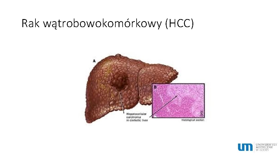 Rak wątrobowokomórkowy (HCC) 