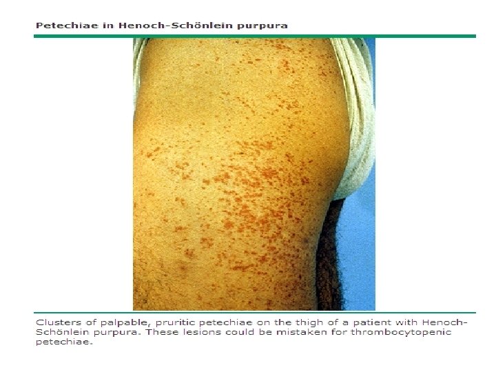 Remove Antigen: Rx Inciting Agent = Fix “ITP” HIV Hepatitis C Helicobacter pylori 