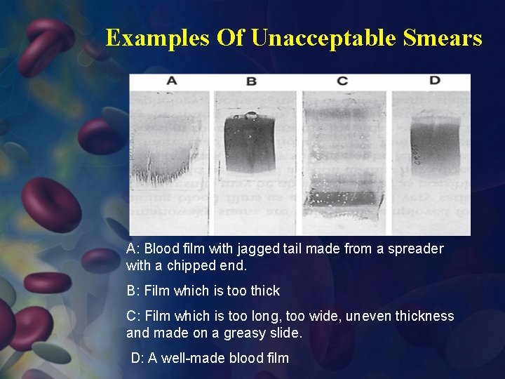 Examples Of Unacceptable Smears A: Blood film with jagged tail made from a spreader