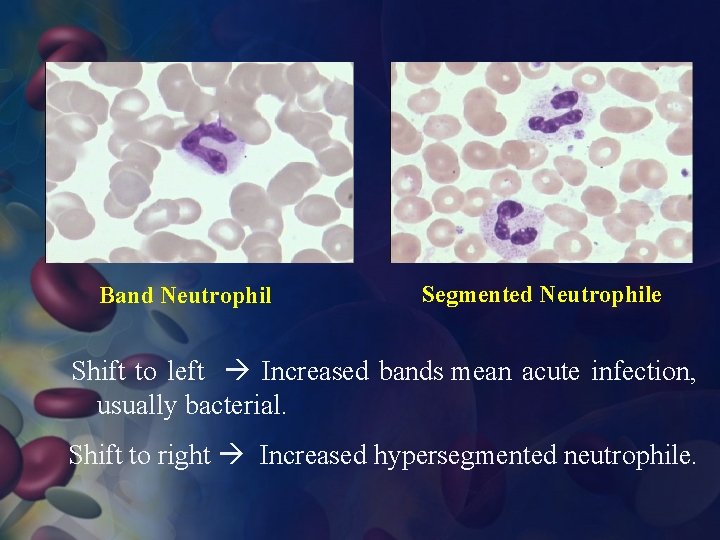 Band Neutrophil Segmented Neutrophile Shift to left Increased bands mean acute infection, usually bacterial.