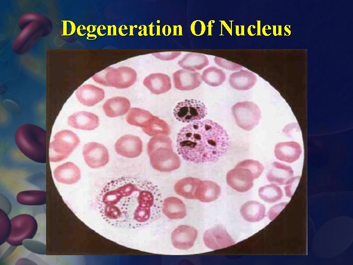 Degeneration Of Nucleus 