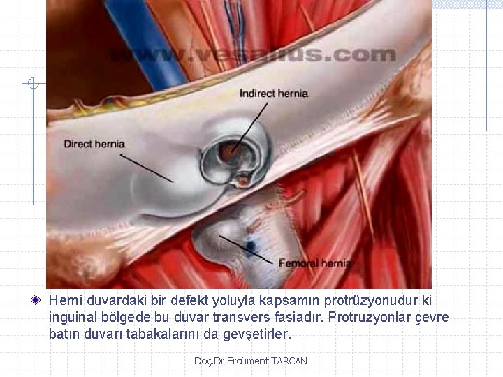 Herni duvardaki bir defekt yoluyla kapsamın protrüzyonudur ki inguinal bölgede bu duvar transvers fasiadır.