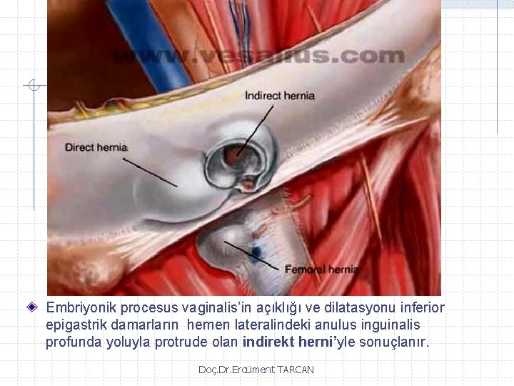 Embriyonik procesus vaginalis’in açıklığı ve dilatasyonu inferior epigastrik damarların hemen lateralindeki anulus inguinalis profunda