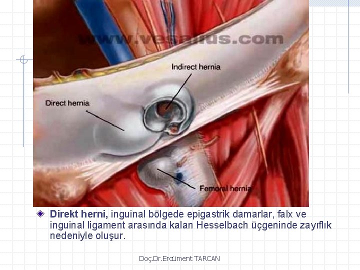 Direkt herni, inguinal bölgede epigastrik damarlar, falx ve inguinal ligament arasında kalan Hesselbach üçgeninde