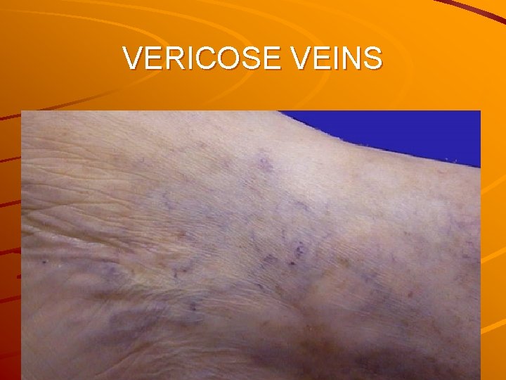 VERICOSE VEINS 