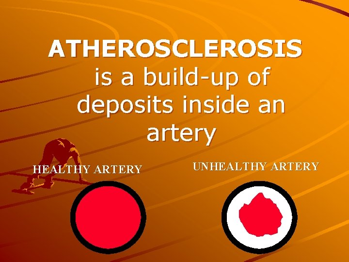 ATHEROSCLEROSIS is a build-up of deposits inside an artery HEALTHY ARTERY UNHEALTHY ARTERY 