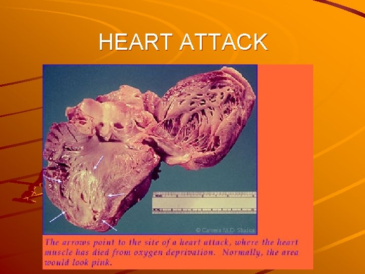 HEART ATTACK 