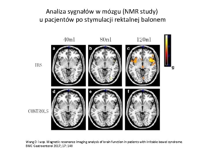 Analiza sygnałów w mózgu (NMR study) u pacjentów po stymulacji rektalnej balonem Wang D