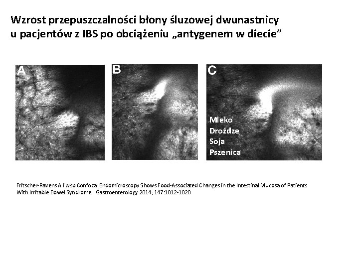Wzrost przepuszczalności błony śluzowej dwunastnicy u pacjentów z IBS po obciążeniu „antygenem w diecie”