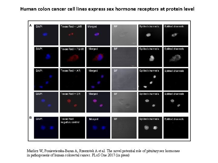 Human colon cancer cell lines express sex hormone receptors at protein level Marlicz W,