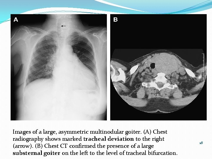 Images of a large, asymmetric multinodular goiter. (A) Chest radiography shows marked tracheal deviation
