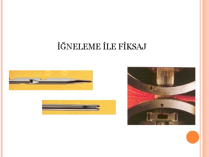 İĞNELEME İLE FİKSAJ 