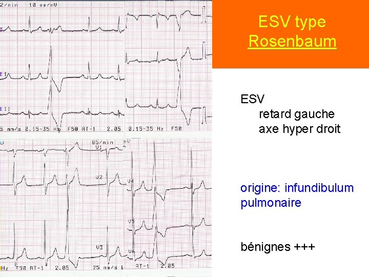 ESV type Rosenbaum ESV retard gauche axe hyper droit origine: infundibulum pulmonaire bénignes +++