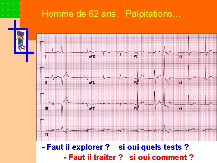 Homme de 62 ans. Palpitations… - Faut il explorer ? si oui quels tests