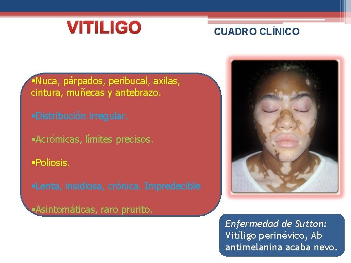 VITILIGO CUADRO CLÍNICO §Nuca, párpados, peribucal, axilas, cintura, muñecas y antebrazo. §Distribución irregular. §Acrómicas,