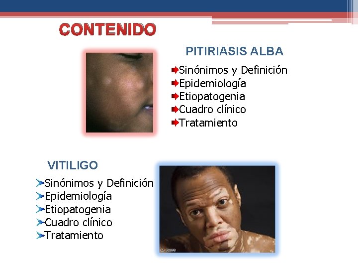 CONTENIDO PITIRIASIS ALBA Sinónimos y Definición Epidemiología Etiopatogenia Cuadro clínico Tratamiento VITILIGO Sinónimos y