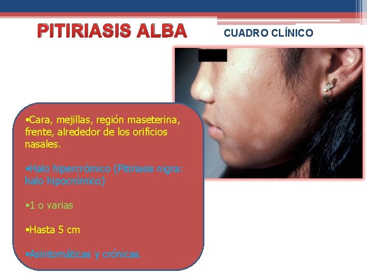 PITIRIASIS ALBA §Cara, mejillas, región maseterina, frente, alrededor de los orificios nasales. §Halo hipercrómico