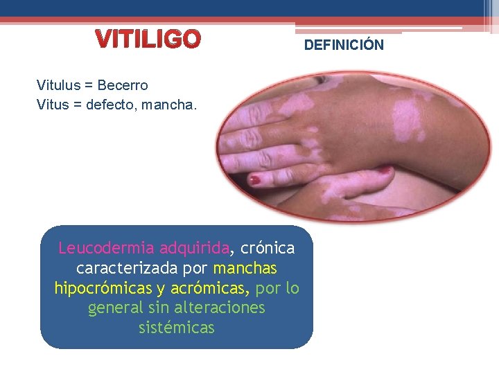 VITILIGO Vitulus = Becerro Vitus = defecto, mancha. Leucodermia adquirida, crónica caracterizada por manchas