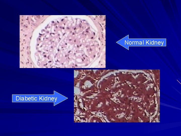 Normal Kidney Diabetic Kidney 