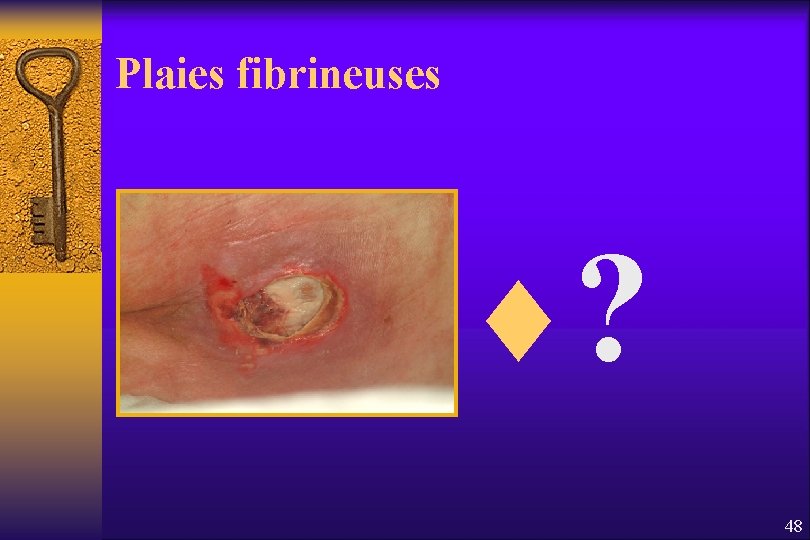 Plaies fibrineuses ¨? 48 