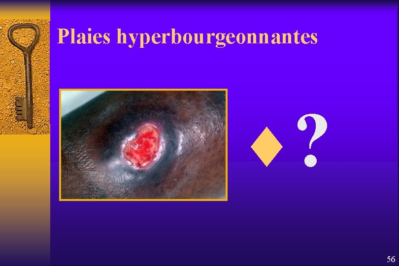 Plaies hyperbourgeonnantes ¨? 56 