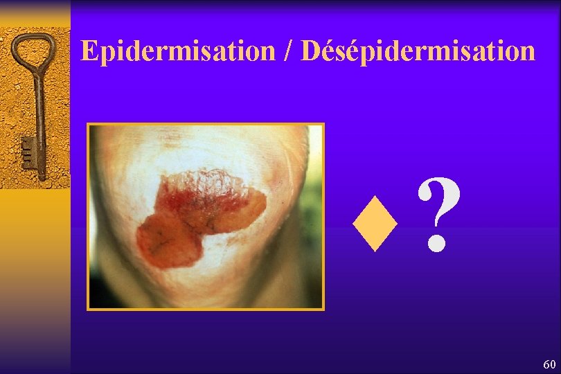 Epidermisation / Désépidermisation ¨? 60 