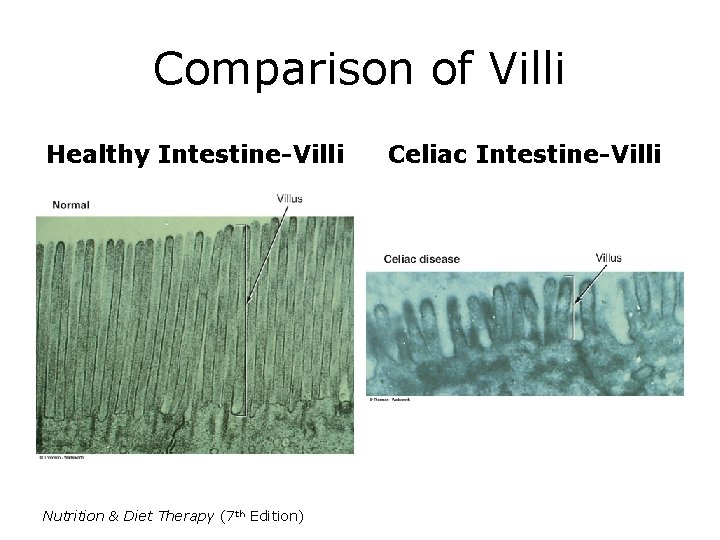 Comparison of Villi Healthy Intestine-Villi Nutrition & Diet Therapy (7 th Edition) Celiac Intestine-Villi