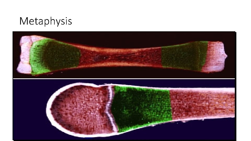 Metaphysis 