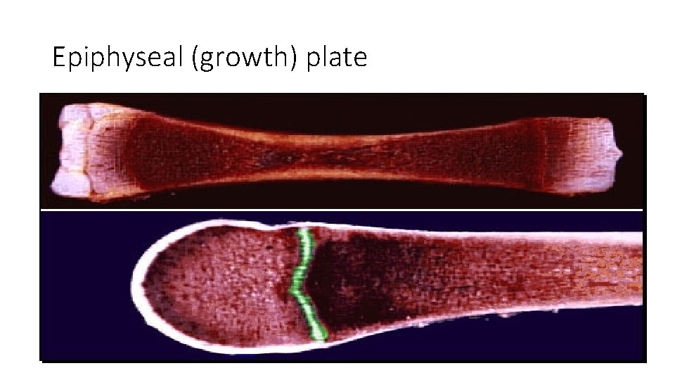 Epiphyseal (growth) plate Epiphyseal (growth) plate