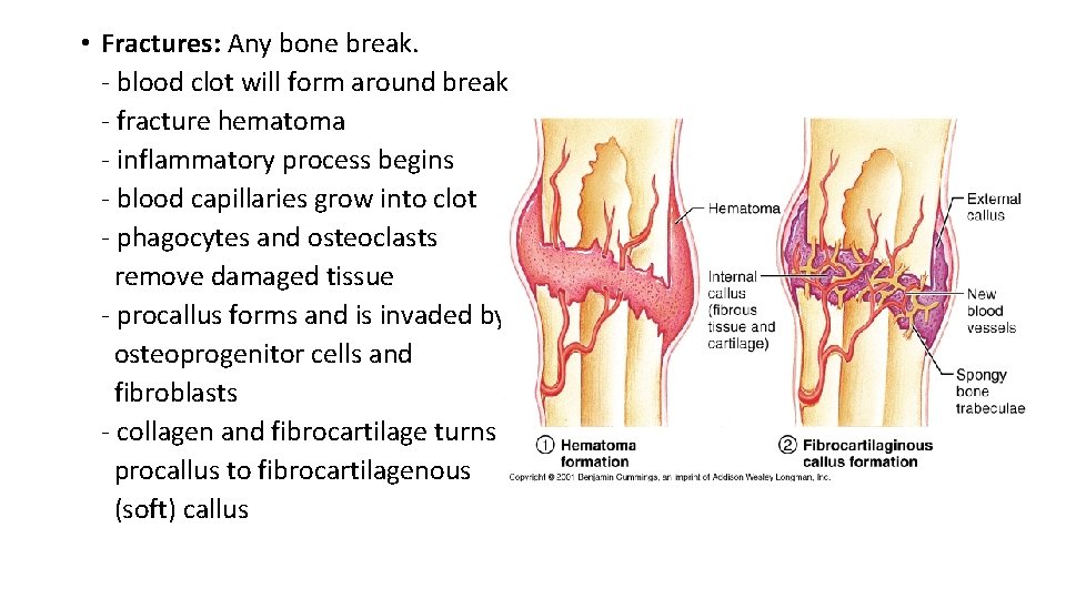  • Fractures: Any bone break. - blood clot will form around break -