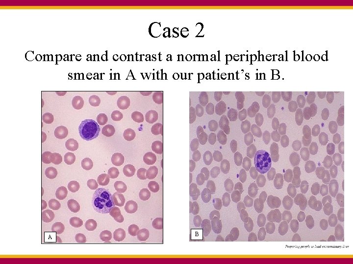 Case 2 Compare and contrast a normal peripheral blood smear in A with our