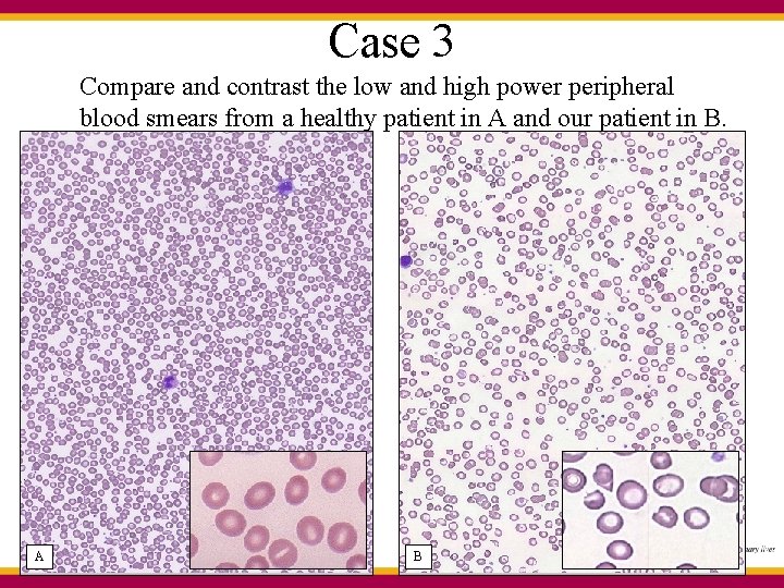 Case 3 Compare and contrast the low and high power peripheral blood smears from