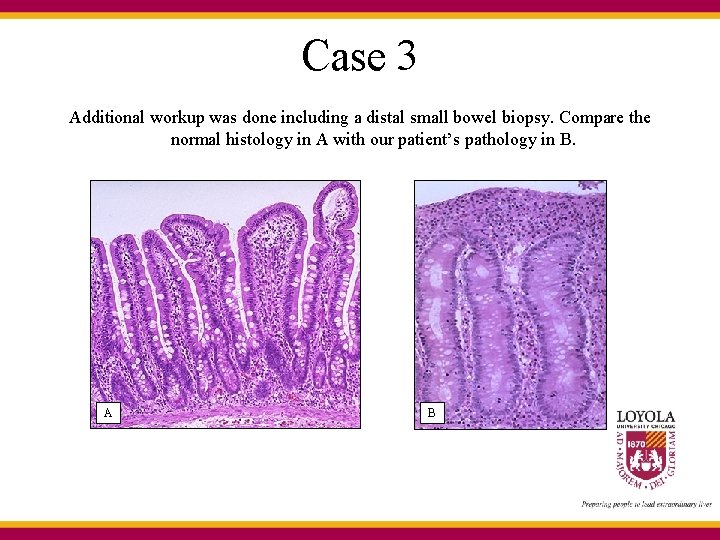 Case 3 Additional workup was done including a distal small bowel biopsy. Compare the