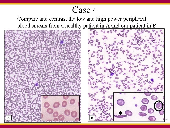 Case 4 Compare and contrast the low and high power peripheral blood smears from