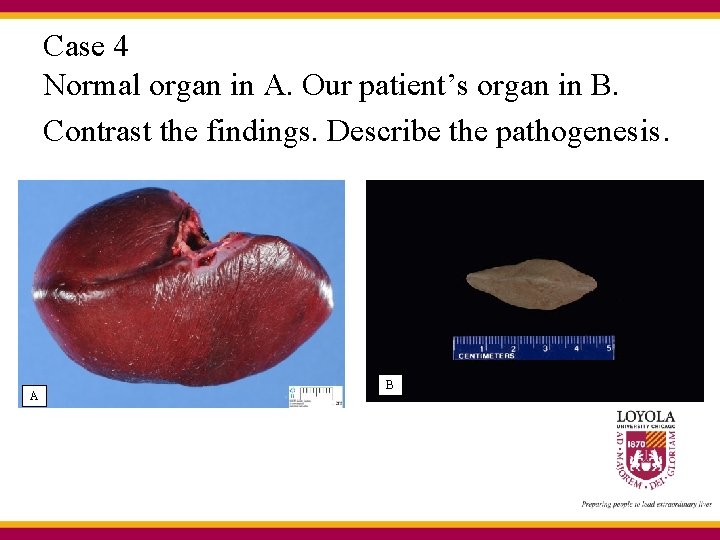 Case 4 Normal organ in A. Our patient’s organ in B. Contrast the findings.