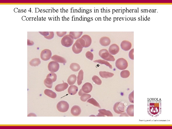 Case 4. Describe the findings in this peripheral smear. Correlate with the findings on