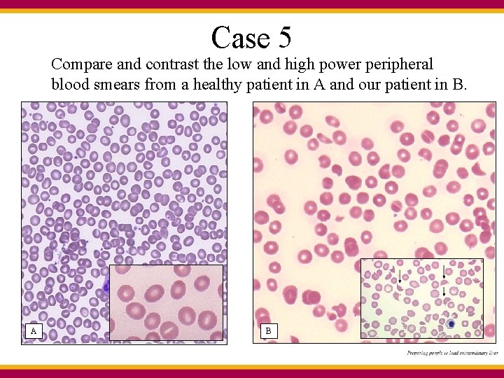 Case 5 Compare and contrast the low and high power peripheral blood smears from