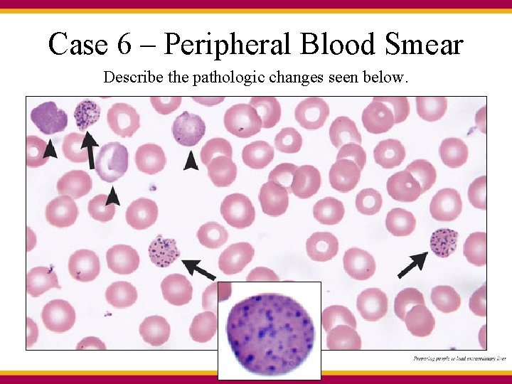 Case 6 – Peripheral Blood Smear Describe the pathologic changes seen below. 