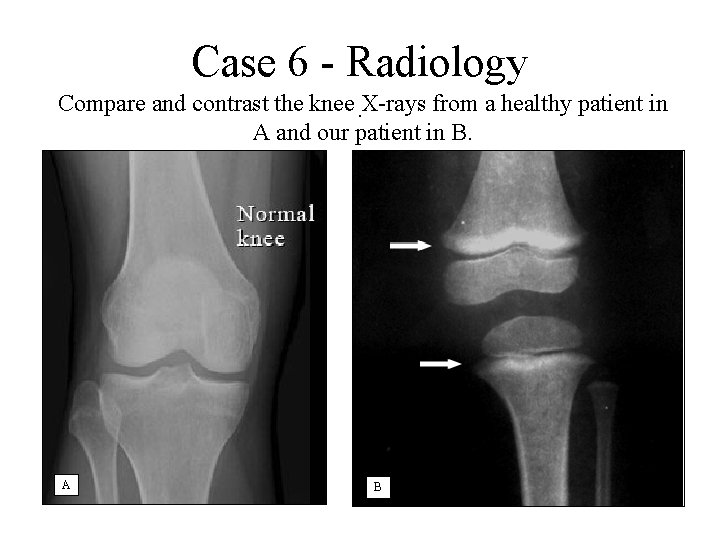 Case 6 - Radiology Compare and contrast the knee. X-rays from a healthy patient
