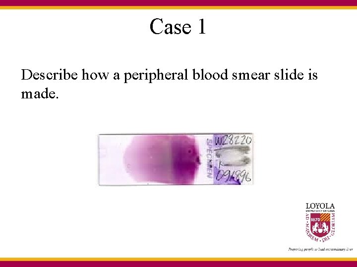 Case 1 Describe how a peripheral blood smear slide is made. 