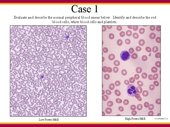 Case 1 Evaluate and describe the normal peripheral blood smear below. Identify and describe