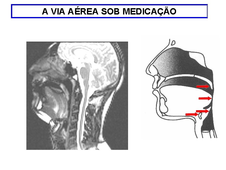 A VIA AÉREA SOB MEDICAÇÃO 