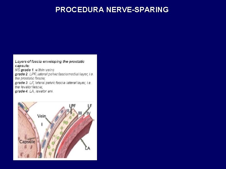 PROCEDURA NERVE-SPARING 