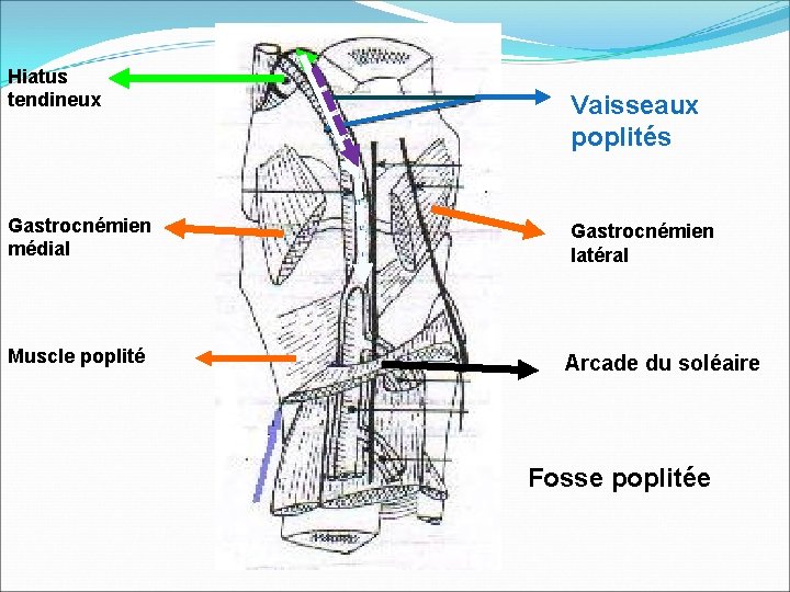 Hiatus tendineux Gastrocnémien médial Muscle poplité Vaisseaux poplités Gastrocnémien latéral Arcade du soléaire Fosse