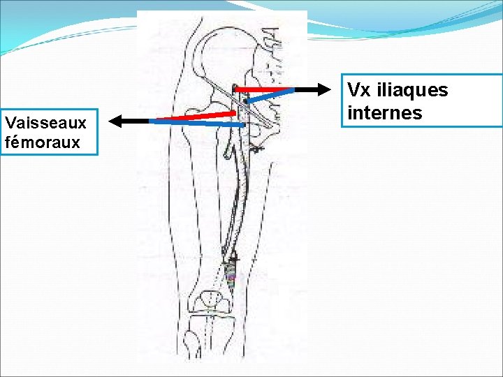 Vaisseaux fémoraux Vx iliaques internes 