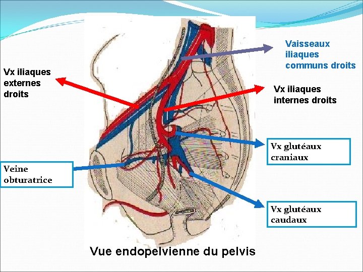 Vaisseaux iliaques communs droits Vx iliaques externes droits Vx iliaques internes droits Vx glutéaux